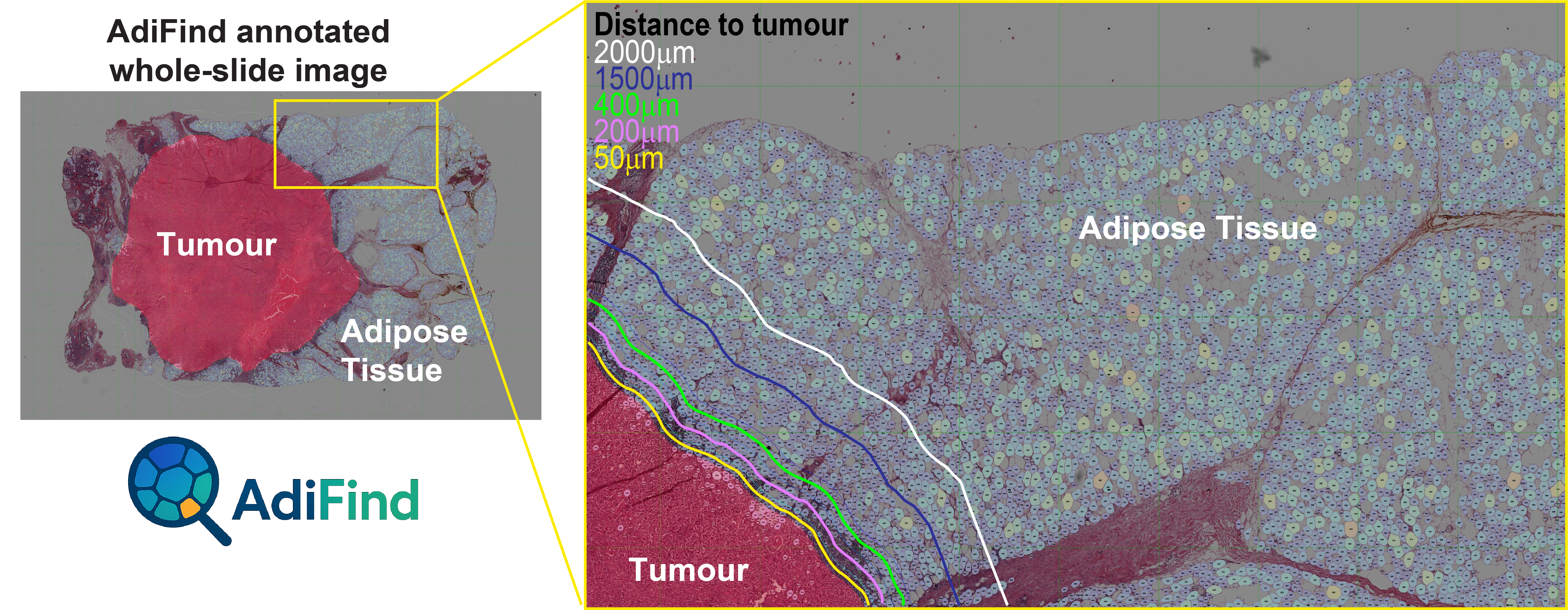 Annotated whole-slide image with tumour and adipose tissue context.